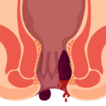 Anal Fissures and Hemorrhoids