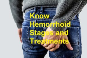 hemorrhoid stages and treatments